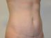 Mini Tummy Tuck After Patient Thumbnail 4