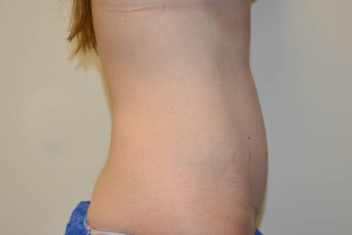 Mini Tummy Tuck After Patient 5