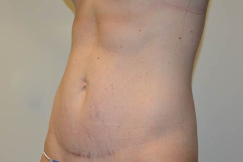 Mini Tummy Tuck After Patient 2