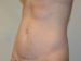 Mini Tummy Tuck After Patient Thumbnail 2