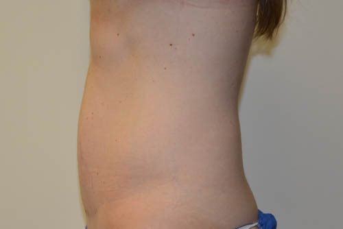 Mini Tummy Tuck After Patient 3