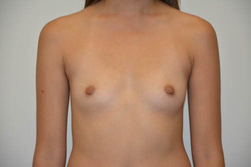 Breast Augmentation Before Patient 1