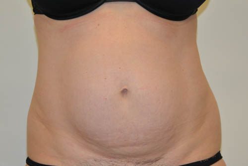 Tummy Tuck Before Patient 1