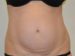 Tummy Tuck Before Patient Thumbnail 1