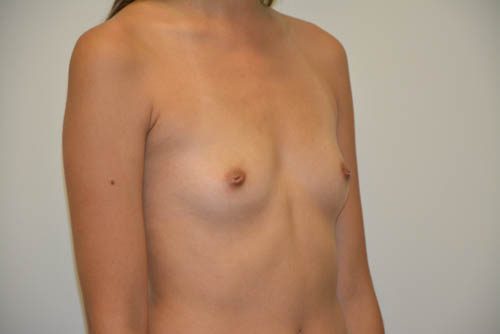 Breast Augmentation Before Patient 4