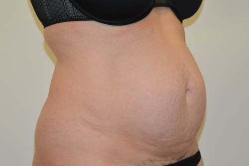 Tummy Tuck Before Patient 2