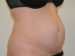 Tummy Tuck Before Patient Thumbnail 2