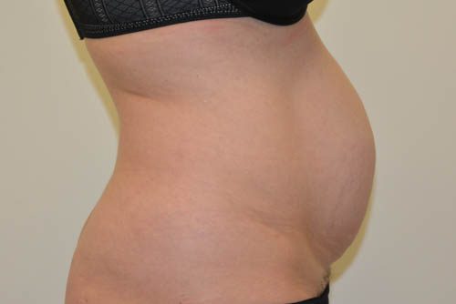 Tummy Tuck Before Patient 3