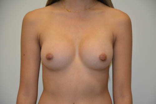 Breast Augmentation After Patient 1