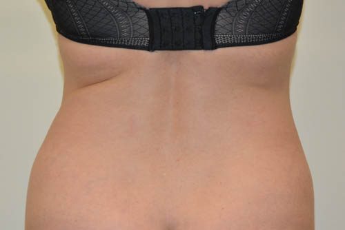Tummy Tuck Before Patient 6
