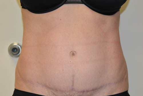 Tummy Tuck After Patient 1