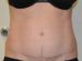 Tummy Tuck After Patient Thumbnail 1