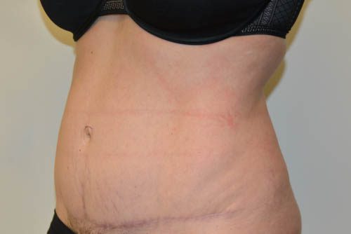 Tummy Tuck After Patient 4