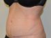 Tummy Tuck After Patient Thumbnail 4