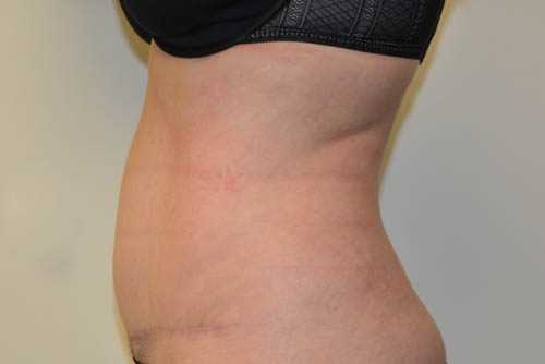 Tummy Tuck After Patient 5