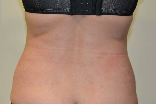 Tummy Tuck After Patient 6