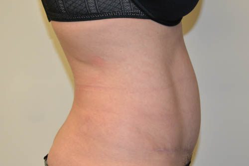 Tummy Tuck After Patient 3