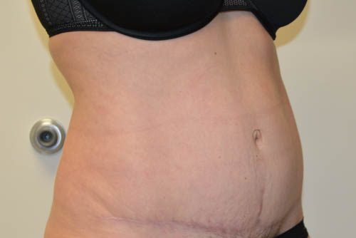 Tummy Tuck After Patient 2