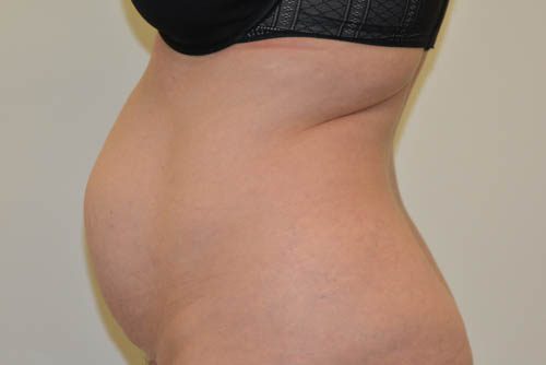 Tummy Tuck Before Patient 5