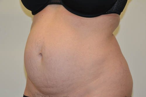 Tummy Tuck Before Patient 4