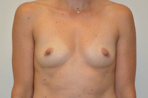 Breast Augmentation Before Patient 1