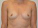 Breast Augmentation Before Patient Thumbnail 1