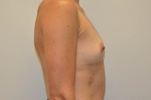 Breast Augmentation Before Patient 3