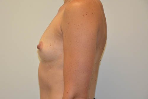 Breast Augmentation Before Patient 5