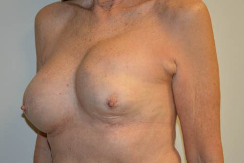 Breast Revision Before Patient 2