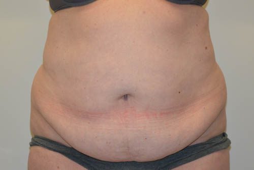 Tummy Tuck Before Patient 1