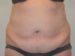 Tummy Tuck Before Patient Thumbnail 1