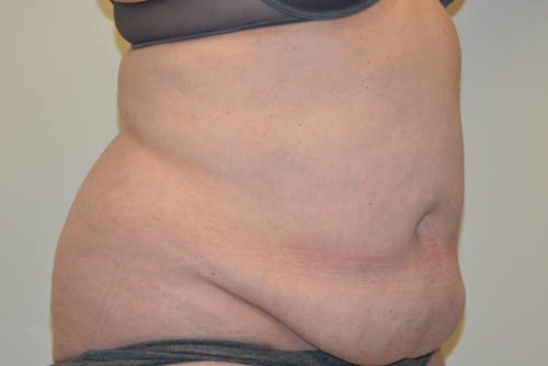 Tummy Tuck Before Patient 4