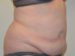 Tummy Tuck Before Patient Thumbnail 4