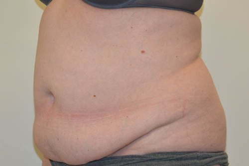 Tummy Tuck Before Patient 2