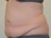 Tummy Tuck Before Patient Thumbnail 2