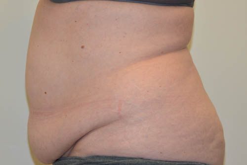 Tummy Tuck Before Patient 3