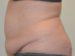 Tummy Tuck Before Patient Thumbnail 3