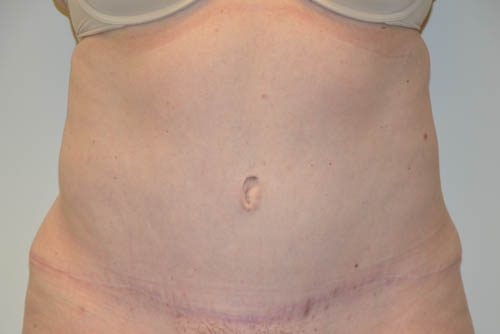 Tummy Tuck After Patient 1