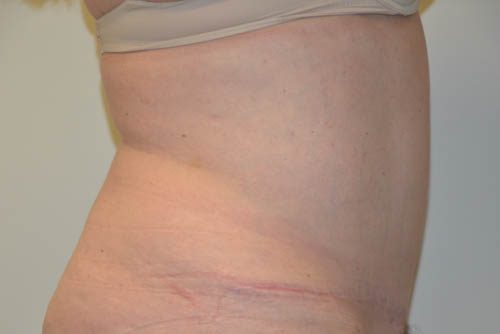 Tummy Tuck After Patient 5