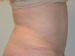 Tummy Tuck After Patient Thumbnail 5