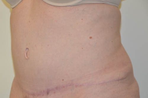 Tummy Tuck After Patient 2