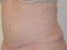 Tummy Tuck After Patient Thumbnail 2