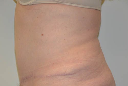 Tummy Tuck After Patient 3