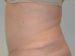 Tummy Tuck After Patient Thumbnail 3