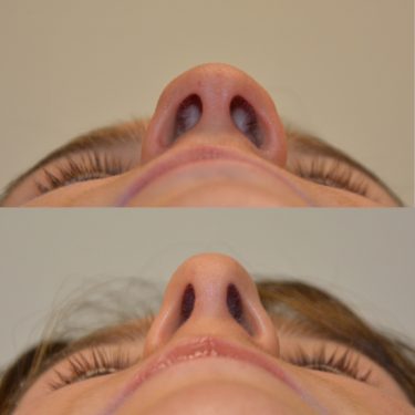 Rhinoplasty Before Patient 2