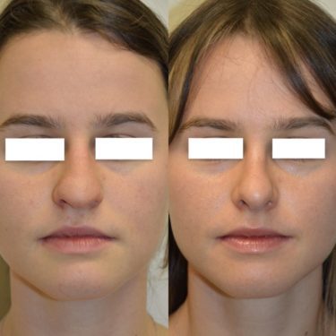 Rhinoplasty After Patient 1