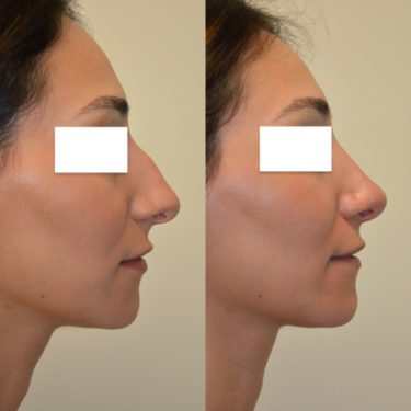 Rhinoplasty Before Patient 2