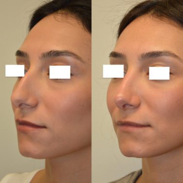 Rhinoplasty After Patient 1