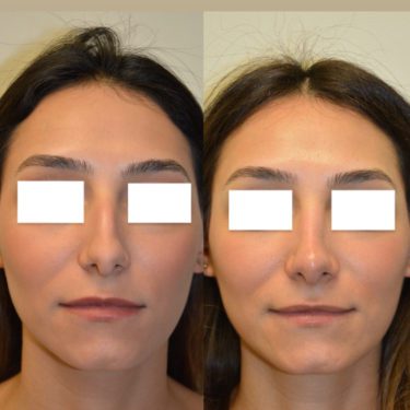 Rhinoplasty Before Patient 3