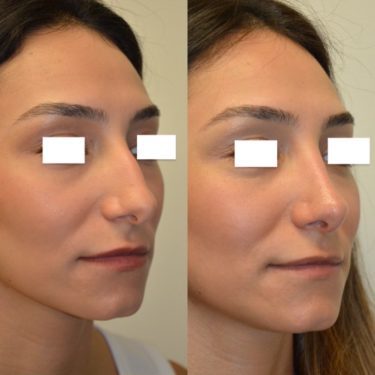 Rhinoplasty After Patient 2